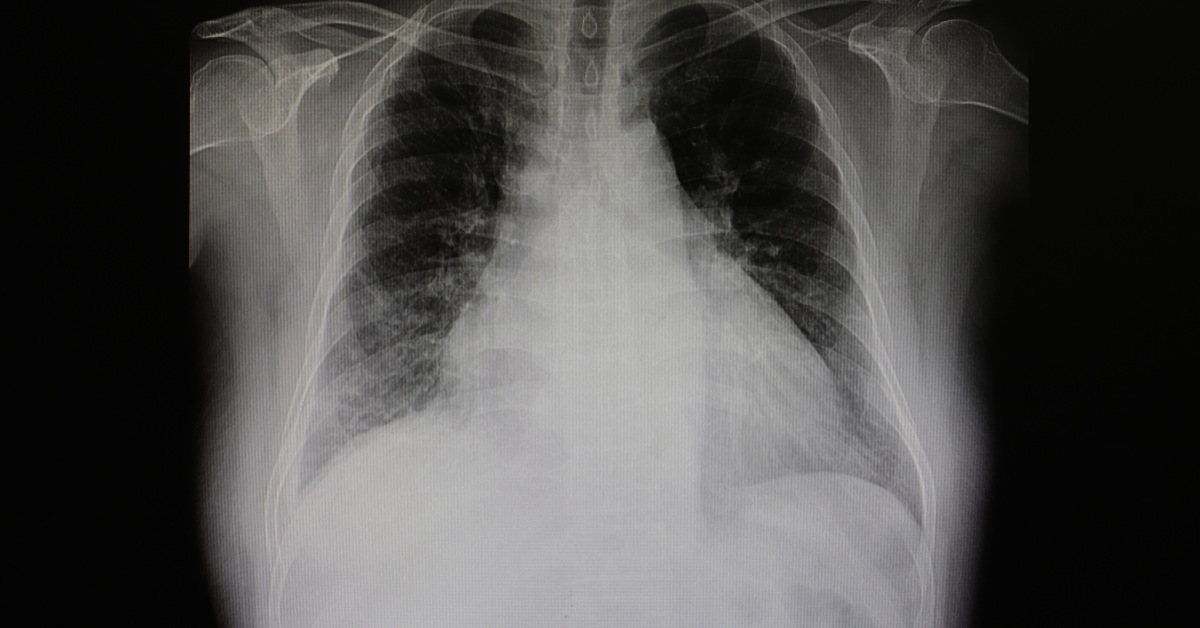 x ray of chest