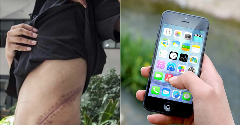surgery scar and iphone
